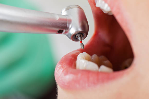 Best Emergency Dental Care for Broken or Chipped Teeth in Birch Bay, WA